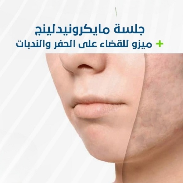 جلسة ميكرونيدلينج + ميزو للقضاء علي الحفر و الندبات